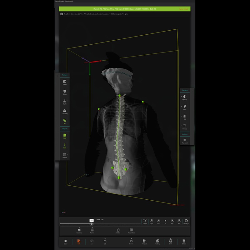 Система трёхмерного сканирования позвоночника Spine3D